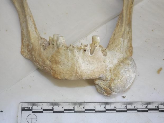 An unusual bony growth (osteoma) on a lower jaw